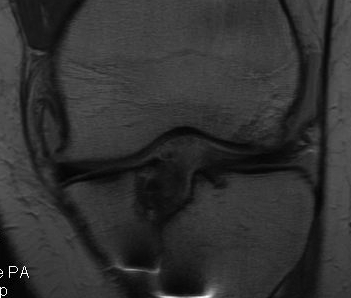 Revision ACL Tibial Tunnel Lysis
